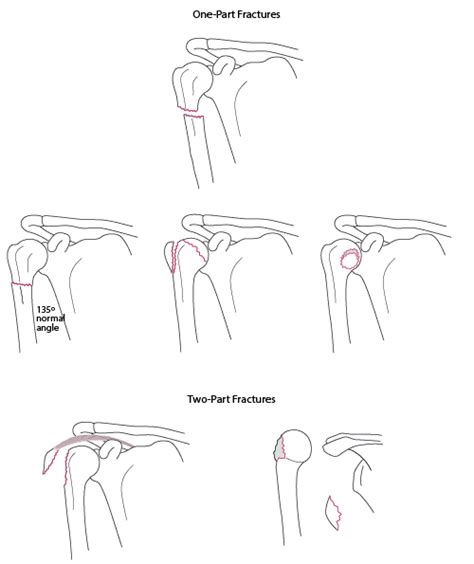 Proximal Humeral Fracture Classification