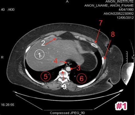 CS Unit 1 Abdomen Lumbar Spine CT Flashcards Quizlet