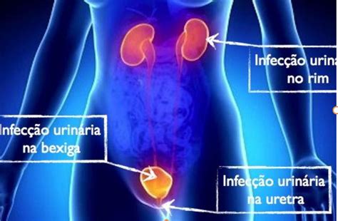 Infecção Urinaria Mulher Sintomas - Infecção Urinária: causas, sintomas, tratamento e quando afastar do ...