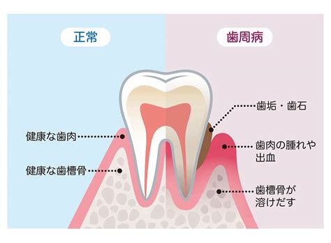 大森で歯周病治療はスケーリングや歯周病検査のできる大森山王あおやま歯科