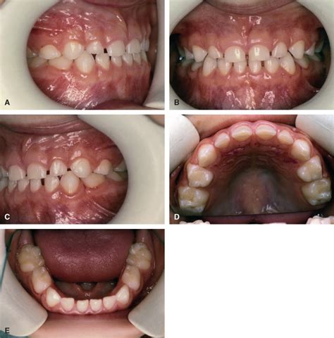 Super Class I Occlusion Tarsha Mcelroy