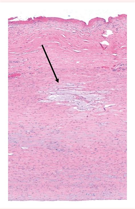 Figure From Giant Ascending Aortic Aneurysm With Impending Rupture As