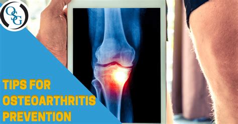 Osteoarthritis Prevention Tips | Orthopedic Specialist Fairfield CT