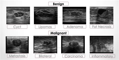 Breast Cancer Images Ultrasound