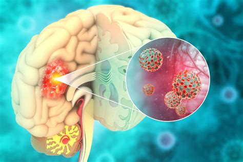 In8bio Wins Fda Orphan Drug Designation For Glioma Candidates Seeking Alpha