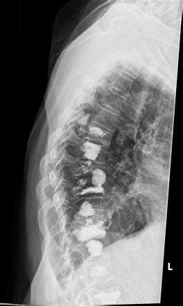 Vertebroplasty And Kyphoplasty Radiology Reference Article