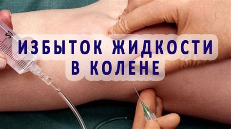 Избыток суставной (синовиальной) жидкости в коленном суставе - YouTube