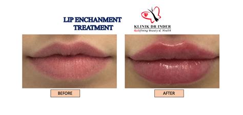 Lip Enhancement | Lip Treatment | Aesthetic Clinic Malaysia