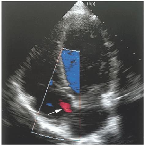 Endocarditis And Other Pathologic And Normal Anatomic Variants Thoracic Key