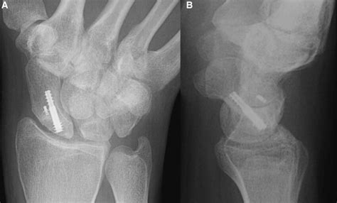 Anteroposterior A And Lateral B Radiographs Of The Right Wrist