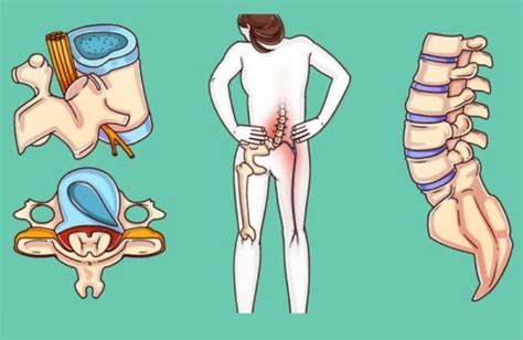 A Surgeon Reveals Exercises That Can Heal Your Spine Before Its Too Late