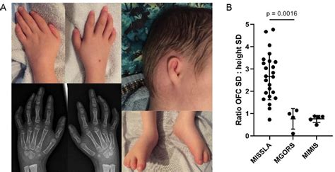 Linked Read Genome Sequencing Identifies Biallelic Pathogenic Variants