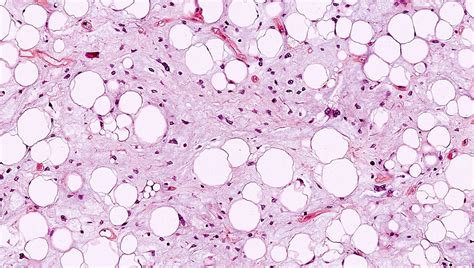 Dedifferentiated Liposarcoma Pathology