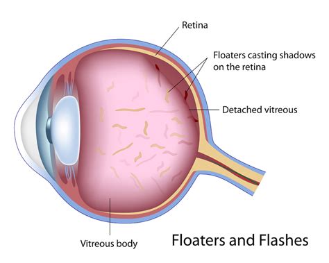 Eye Floaters: Causes, Symptoms & Treatment Options