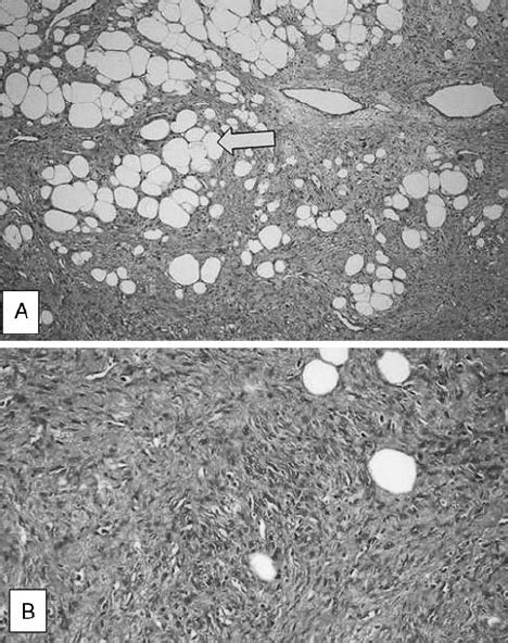 A Photomicrograph Of The Histopathology Of Lipomatous Download Scientific Diagram