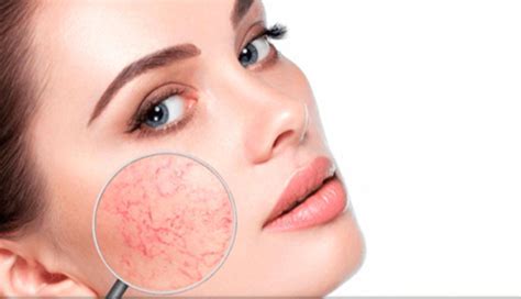 Tratamento De Acne E Rosácea Dermatologia Clínica Dra Thalita Mendes