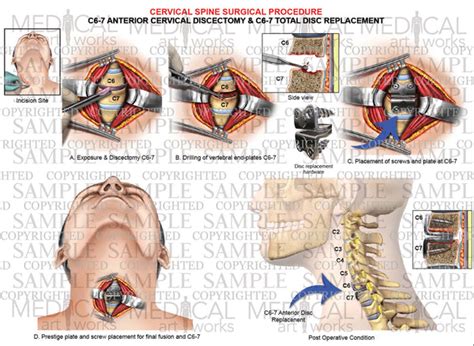 1 Level - C6-C7 anterior cervical discectomy and fusion - cervical ...