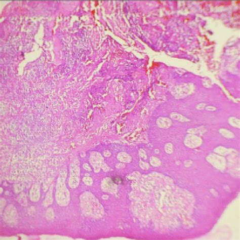 Pyogenic Granuloma With Hyperplastic Epithelium That Overlies A Fibrous