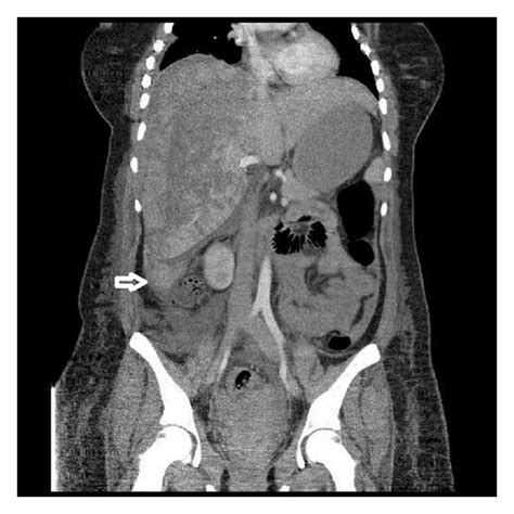 Hellp Syndrome Complicated By Subcapsular Hematoma Of Liver A Case Report And Review Of The