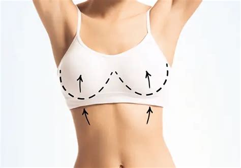 Comprehensive Guide To Breast Lift Mastopexy Surgery