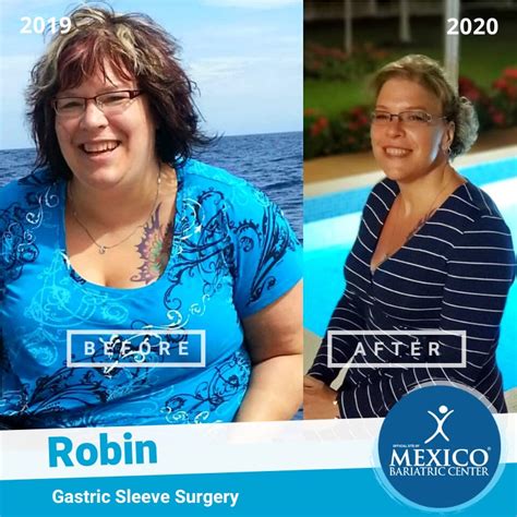 Choosing A Bariatric Surgery Surgeon In Mexico Patient Guidelines