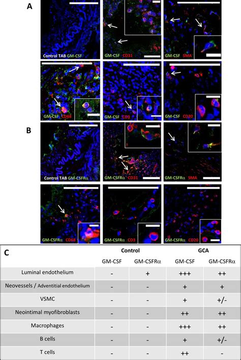 Blocking GM CSF receptor α with mavrilimumab reduces infiltrating cells