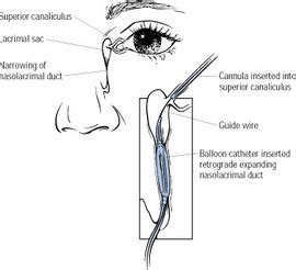 -- Lacrimal Duct Dilatation - Swiss Ophthalmologist at Train Station ...