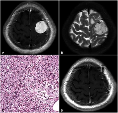 Clinical And Radiological Characteristics Of Angiomatous Meningiomas Pmc