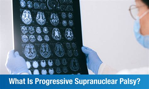 4 Stages Of Progressive Supranuclear Palsy Plexus