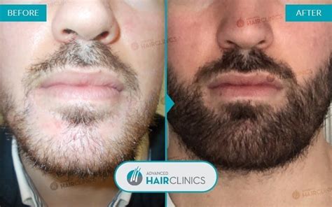 Fue Beard Transplant Advanced Hair Clinics