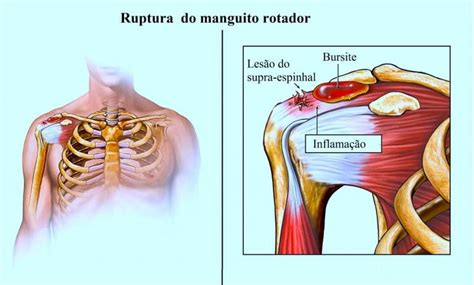 S Ndrome Do Impacto Do Ombro Esquerda Ou Direita