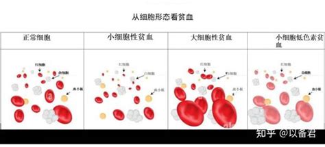 贫血的分类及诊断如何看血常规报告 知乎