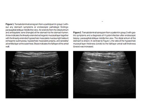 BÀI SOẠN VỀ SIÊU ÂM CHẨN ĐOÁN: GASTRIC ULTRASOUND: ANTRAL GASTRITIS and ...