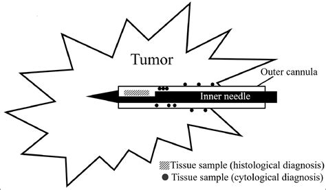 Effectiveness Of Cytological Diagnosis With Outer Cannula Washing