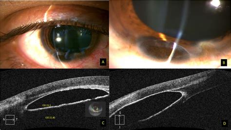 Figure 1 From Optical Coherence Tomography And ImageJ Software For