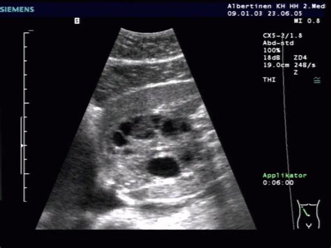 Echinococcus Cyst Doccheck