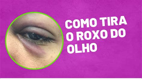 Como Tirar Roxo do olho Hematomas no corpo e Chupão no pescoço YouTube