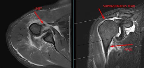 Full Thickness Supraspinatus Infraspinatus Tendon Tear With