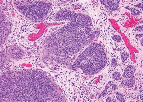 Invasive Urothelial Carcinoma Abdominal Key