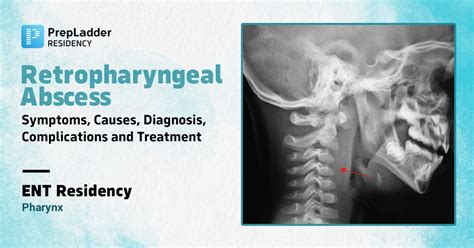 Retropharyngeal Abscess : Symptoms, Causes, Diagnosis, Complications and Treatment