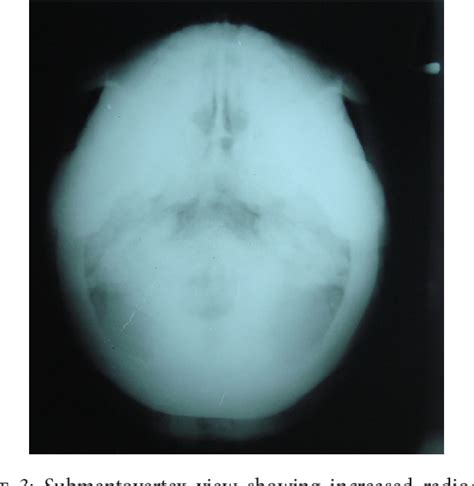 Figure 1 From Clinical And Radiological Findings Of Autosomal Dominant