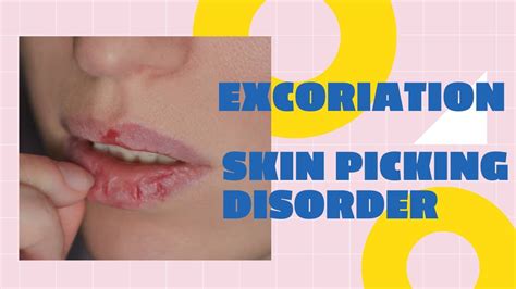 Excoriation Skin Picking Disorder Ocd Treatment Youtube