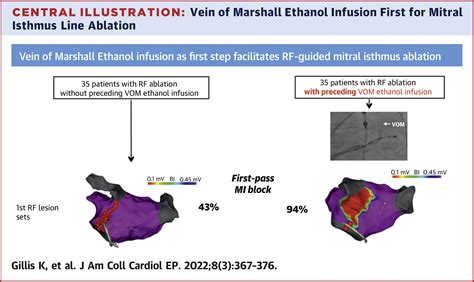 Vein Of Marshall Ethanol Infusion As First Step For Mitral Isthmus