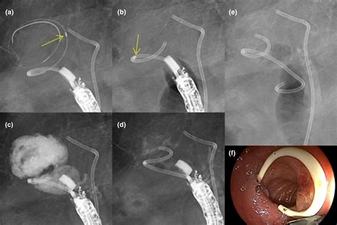 Simple Endoscopic Ultrasoundguided Gallbladder Aspiration Irrigation