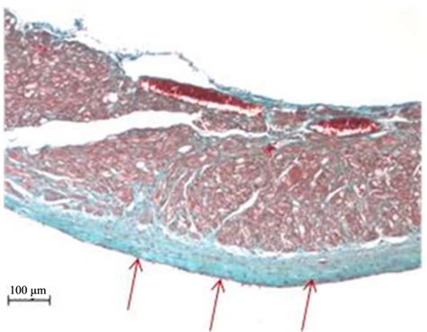 Biomarkers And Atrial Fibrillation A New Paradigm For Assessing The