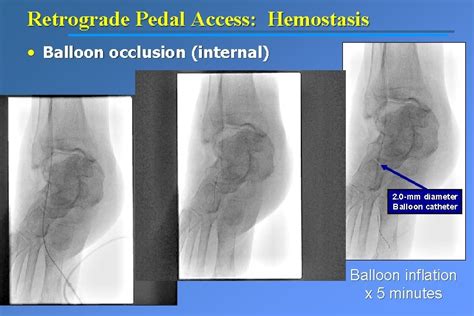 Peripheral Arterial Disease Critical Limb Ischemia Pedal Approach