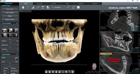 La Importancia Del Tac Dental En Odontolog A Grupo Scanner Vizcaya