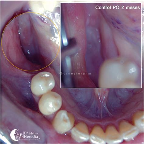 Osteoradionecrosis of the jaw – Dr. Néstor Heredia