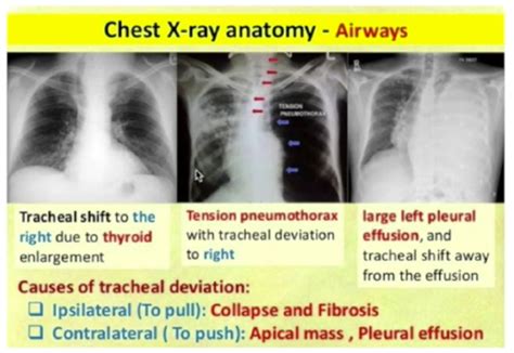 Tension Pneumothorax Tracheal Deviation