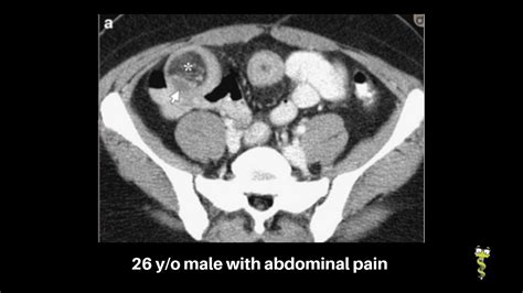 Adult with Meckel's diverticulum - YouTube